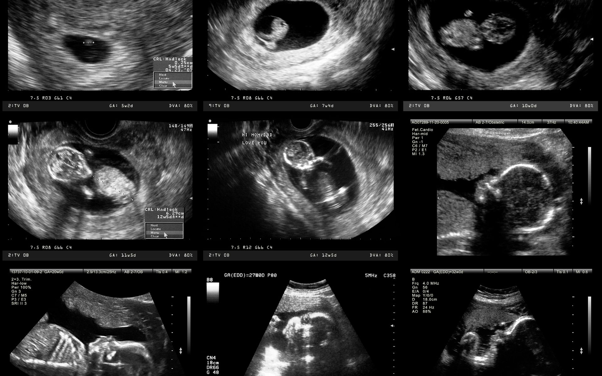 Προγεννητικός έλεγχος εμβρύου